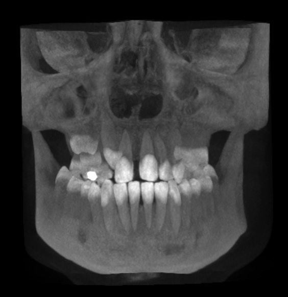 orthodontie adulte chirurgie promandibulie CBCT 3D cone beam