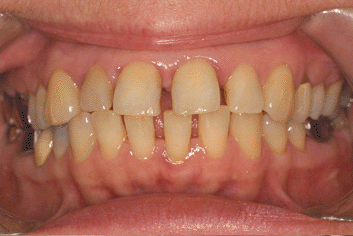 Orthodontie, adulte, photographie endo-buaccale, diastèmes
