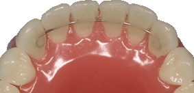 orthodontie, orthodontiste, adulte, contention fixe, attelle collée, fil collé