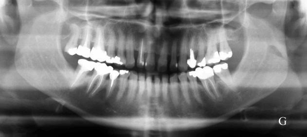 Orthodontie, adulte, panoramique dentaire