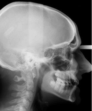 orthodontie, adulte, téléradiographie du crâne