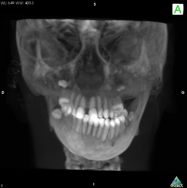 orthodontie traitement ortho-chirugical syndrôme oto-mandibulaire