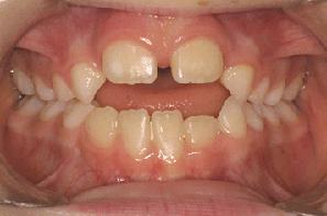 orthodontie orthodontiste béance prévention succion pouce