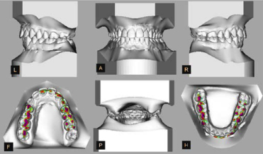 orthodontie empreintes numériques dentaires