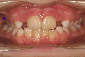 orthodontie orthodontiste endo-alvéolie maxillaire