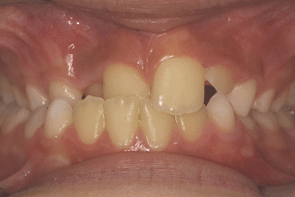 orthodontie orthodontiste inversé d'articulé antérieur