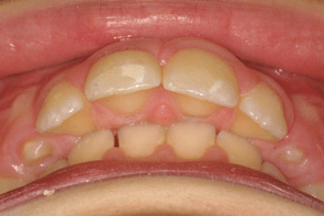 orthodontie orthodontiste morsure palatine