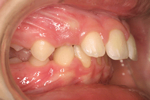 orthodontie orthodontiste pro-alvéolie