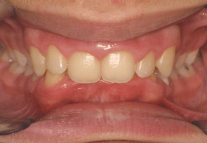 orthodontie orthodontiste supraclusion incisive supraclusie
