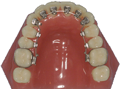 orthodontie, appareil multi-attaches, appareil multi-bagues, appareil lingual, orthodontie invisible