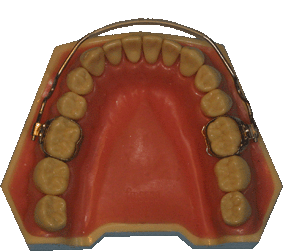 orthodontie, lip-bumper