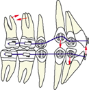 orthodontie, appareil multi-attaches, appareil multi-bagues, étapes, étapes 2