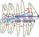 orthodontie, appareil multi-attaches, appareil multi-bagues, étapes, étapes 4