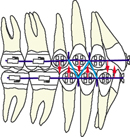 orthodontie, appareil multi-attaches, appareil multi-bagues, étapes, étapes 5