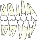 orthodontie, appareil multi-attaches, appareil multi-bagues, étapes, étapes 6