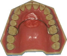 orthodontie, appareil de nance