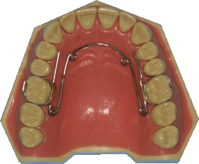 orthodontie, quad-hélix, quad-helix
