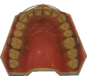 orthodontie, appareil amovible, plaque à ressort et à bandeau vestibulaire, gouttières, aligneurs, orthodontie esthétique, orthodontie invisible